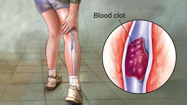 dvt