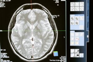 stroke and physiotherapy